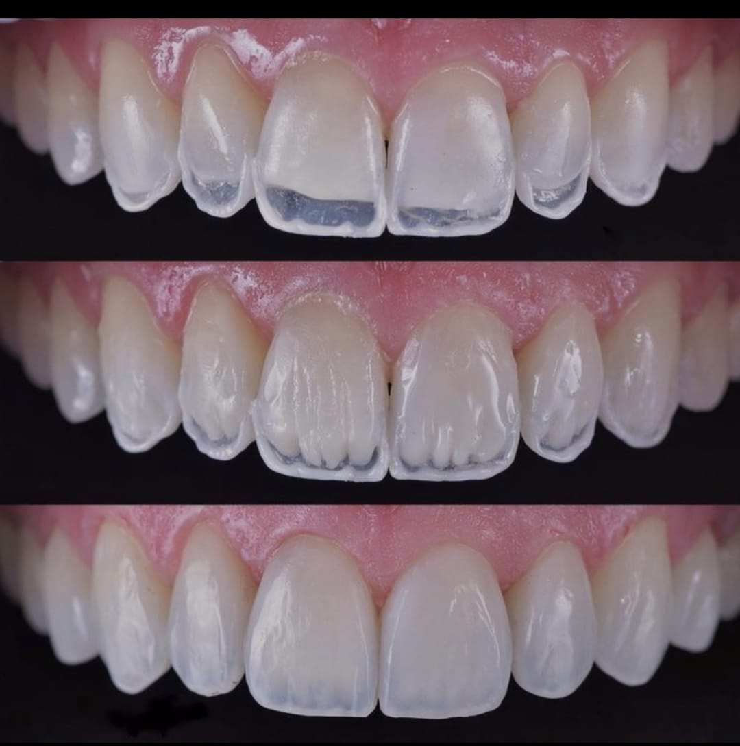 Resultado de diseño de sonrisa con carillas estéticas en Collazos Odontología Integral