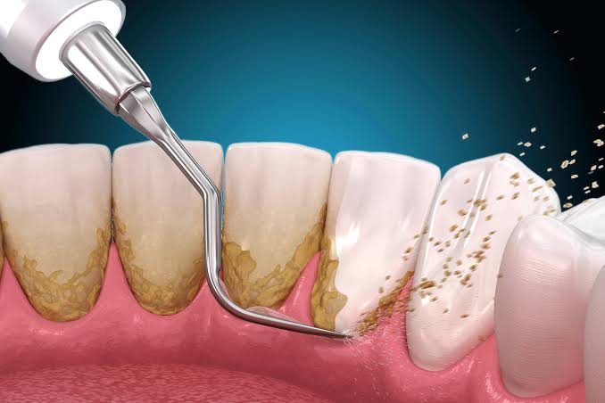Tratamiento dental profesional en Collazos Odontología Integral